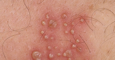 Is Ayurveda Effective against Herpes Infection